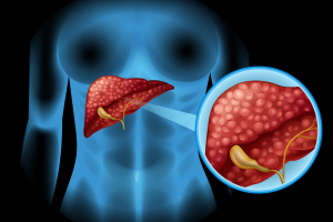FDA Approves Wegovy® for Treatment of MASH with Moderate to Advanced Liver Fibrosis