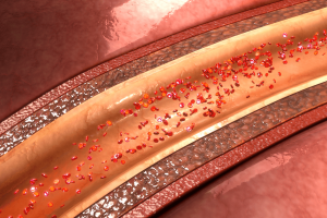 Improving risk stratification in NSTE-ACS through the extended GRACE score