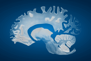Pre- and Post-Diagnostic Incidence of Depression in Parkinson’s Disease and Lewy Body Dementia
