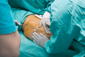 The Future of Liposuction: AI-Powered Blood Loss Prediction Improves Care