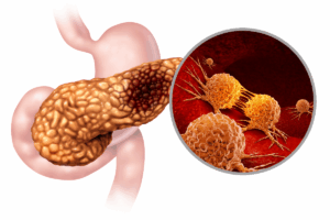 FDA Authorizes Innovative Non-Invasive Device for Locally Advanced Pancreatic Cancer