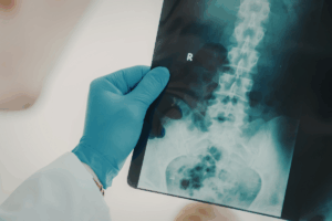 From Immunity to Bones: Collectin-11 Found to Guide Osteoclast Formation